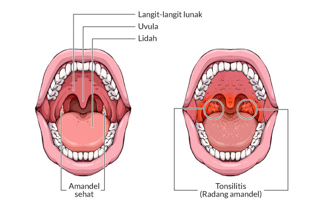 Makanan Yang Memicu Radang Amandel Panduan Lengkap Untuk Menjaga Kesehatan Tenggorokan Anda